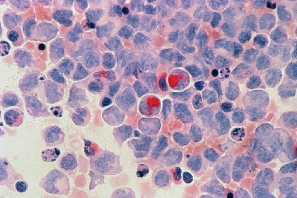 National Cancer Institute image from clinical trail